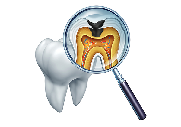 虫歯の原因について知っていますか？
